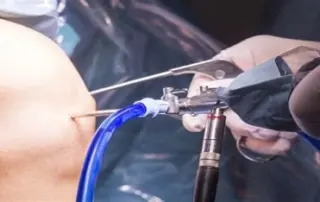 What Is Arthroscopic Knee Surgery?